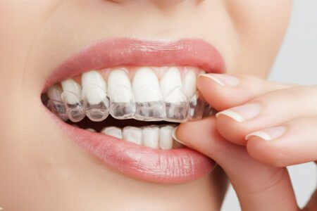 Aligner-Schiene für Jugendliche in Frankfurt am Main – nahezu unsichtbare Zahnkorrektur mit modernen Invisalign-Systemen bei Skyline Kieferorthopädie im Europaviertel, direkt an der Skyline Plaza.