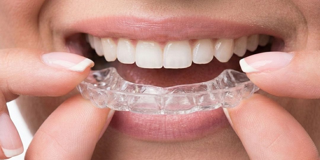 Transparente Knirschschiene vor den Zähnen eines Erwachsenen zur Behandlung von Zähneknirschen