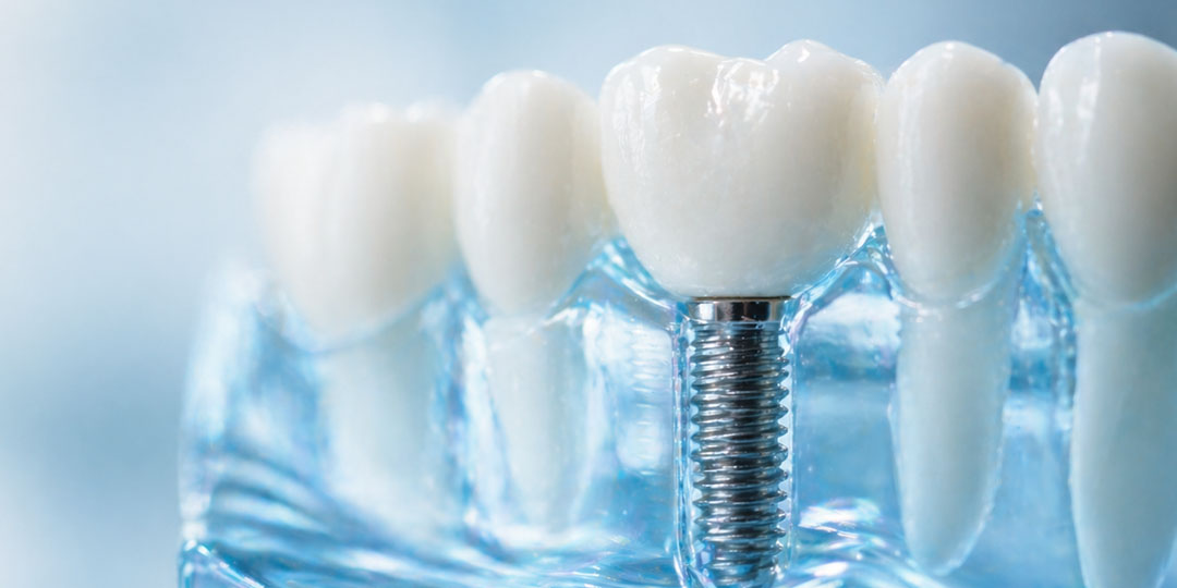 Zahnmodell mit Implantat und Zahnkrone – Miniimplantate für Erwachsene bei Skyline Kieferorthopädie Frankfurt