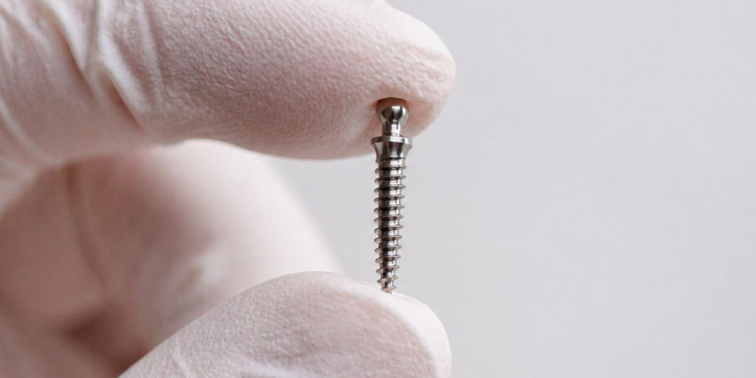 Nahaufnahme eines Miniimplantats aus Titan in behandschuhten Fingern – Skyline Kieferorthopädie Frankfurt